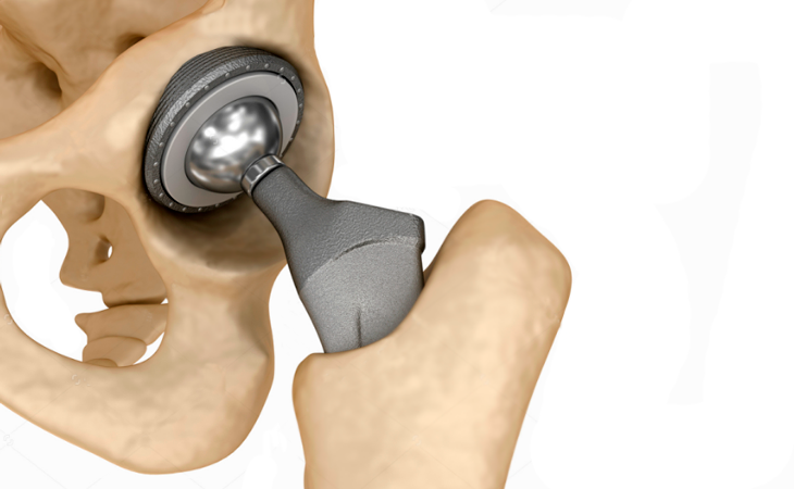 Artroplastia do Quadril